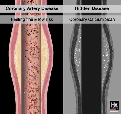 From Medmovie's Youtube Short: Hidden Disease - Coronary Artery Disease (CAD) From Medmovie's Youtube Short: Hidden Disease - Coronary Artery Disease (CAD)